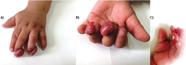 Figura 1. A) Nódulos de 14x10 mm y 17x14 mm en el extremo distal de tercer y cuarto dedo respectivamente de mano izquierda. B) Detalle de las lesiones. C) Ulceración en la superficie nodular del dedo anular.